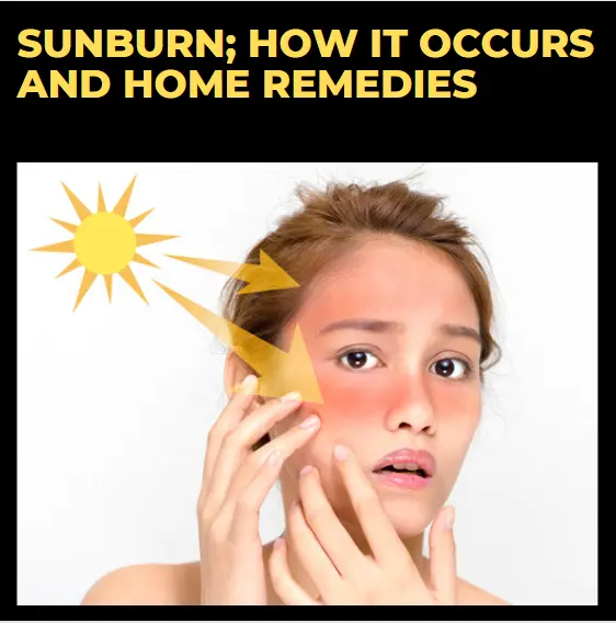 Sunburn; How it occurs and Home Remedies